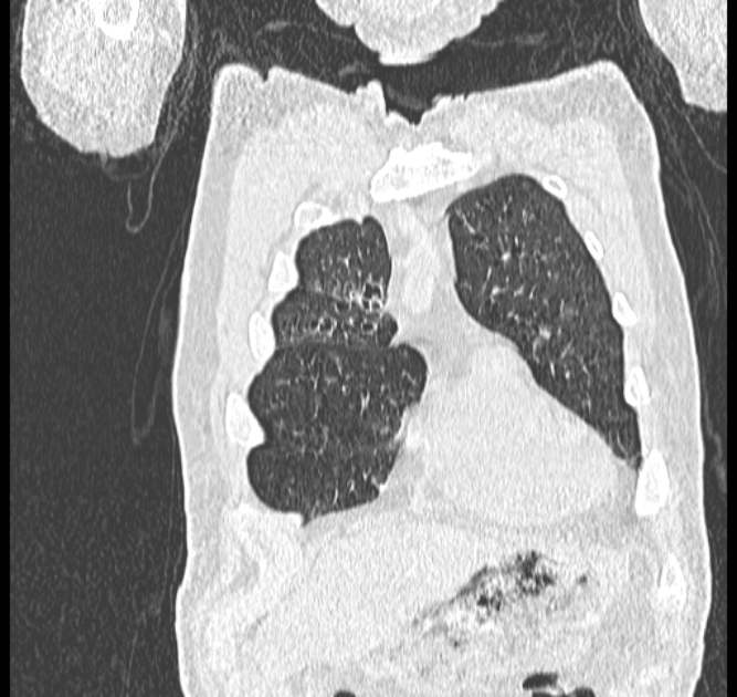 Aspergilloma (Radiopaedia 44592-48327 Coronal lung window 13).jpg