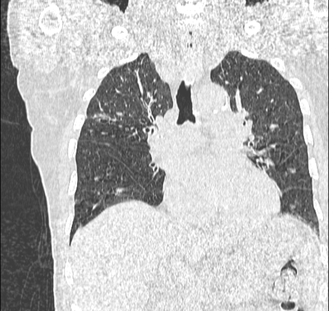 Aspergilloma (Radiopaedia 44592-48327 Coronal lung window 61).jpg