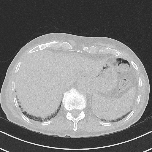Aspergilloma on background pulmonary fibrosis (Radiopaedia 60942-68757 A 49).jpg