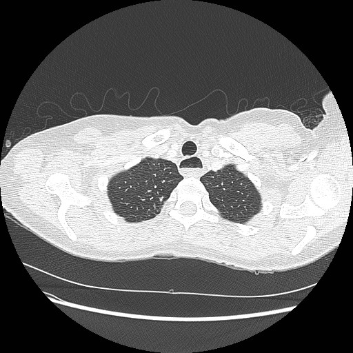 Aspiration pneumonia secondary to laparoscopic banding (Radiopaedia 18345-18183 lung window 9).jpg