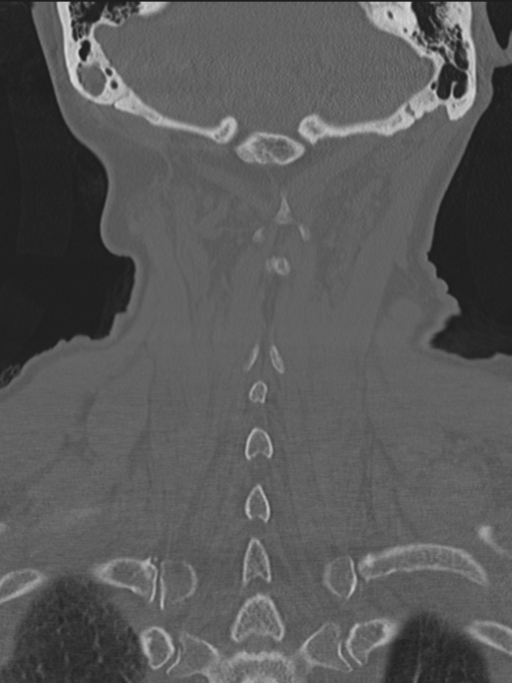 Atlanto-axial subluxation (Radiopaedia 36610-38176 Coronal bone window 41).png