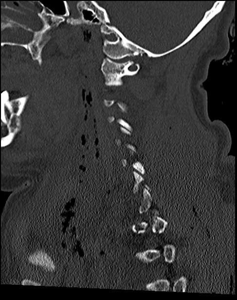 Atlanto-occipital dissociation - Traynelis type 1 (Radiopaedia 87570-103948 Sagittal bone window 35).jpg