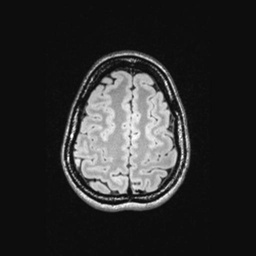 Atretic encephalocoele with inferior vermis hypoplasia (Radiopaedia 30443-31108 Axial 126).jpg