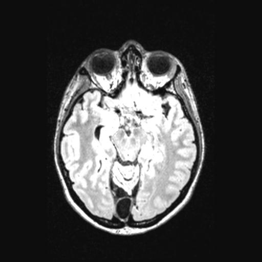 Atretic encephalocoele with inferior vermis hypoplasia (Radiopaedia 30443-31108 Axial 67).jpg