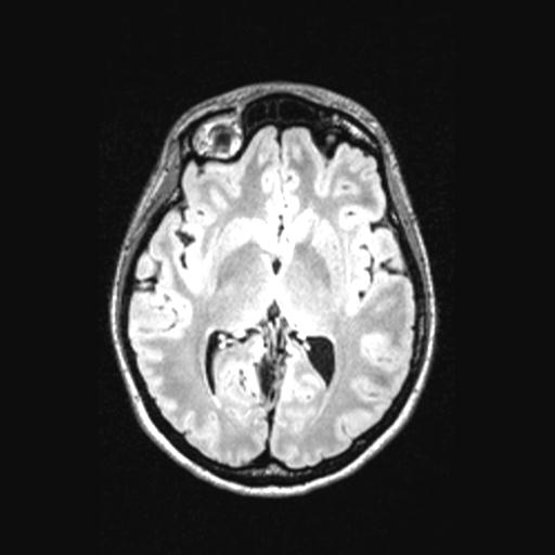 Atretic encephalocoele with inferior vermis hypoplasia (Radiopaedia 30443-31108 Axial 80).jpg