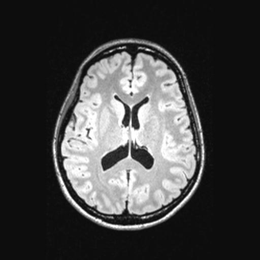 Atretic encephalocoele with inferior vermis hypoplasia (Radiopaedia 30443-31108 Axial 92).jpg