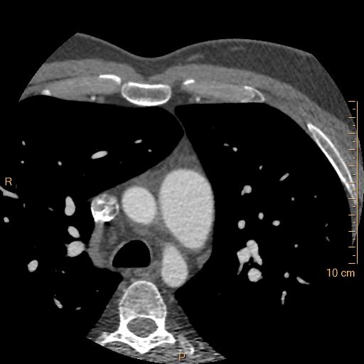 Atrial septal defect (upper sinus venosus type) with partial anomalous pulmonary venous return into superior vena cava (Radiopaedia 73228-83961 A 22).jpg
