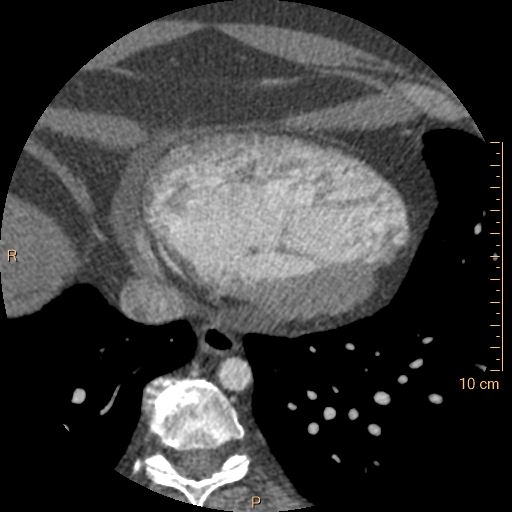 File:Atrial septal defect (upper sinus venosus type) with partial anomalous pulmonary venous return into superior vena cava (Radiopaedia 73228-83961 A 224).jpg