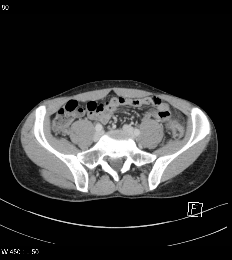 Atypical acute epiploic appendagitis (Radiopaedia 55479-61943 A 79).jpg