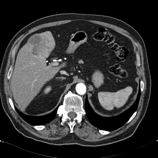 Atypical hepatocellular carcinoma (Radiopaedia 41744-44698 A 27).jpg