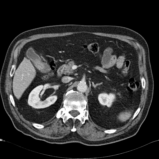 Atypical hepatocellular carcinoma (Radiopaedia 41744-44698 B 33).jpg