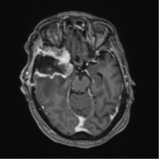 Atypical meningioma (WHO Grade II) (Radiopaedia 54742-60981 Axial T1 C+ 26).png