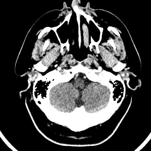 Atypical meningioma (WHO grade II) with brain invasion (Radiopaedia 57767-64728 Axial C+ 49).png