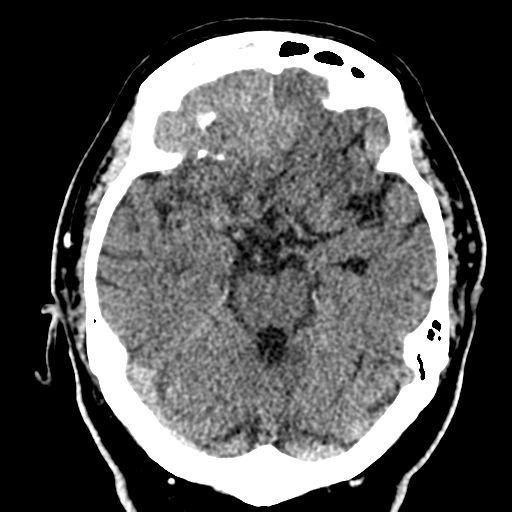 File:Atypical meningioma (WHO grade II) with brain invasion (Radiopaedia 57767-64728 Axial non-contrast 13).png