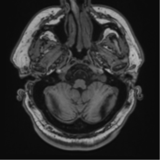 File:Atypical meningioma (WHO grade II) with brain invasion (Radiopaedia 57767-64729 Axial T1 7).png