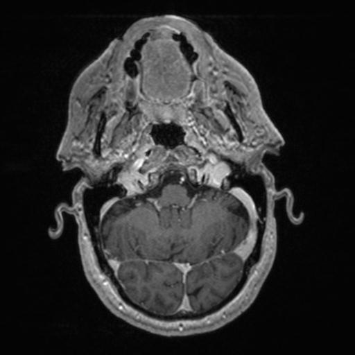 Atypical meningioma (grade II) - en plaque (Radiopaedia 29633-30147 Axial T1 C+ 44).jpg