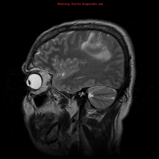 File:Atypical meningioma - grade II (Radiopaedia 13303-13305 Sagittal T2 6).jpg
