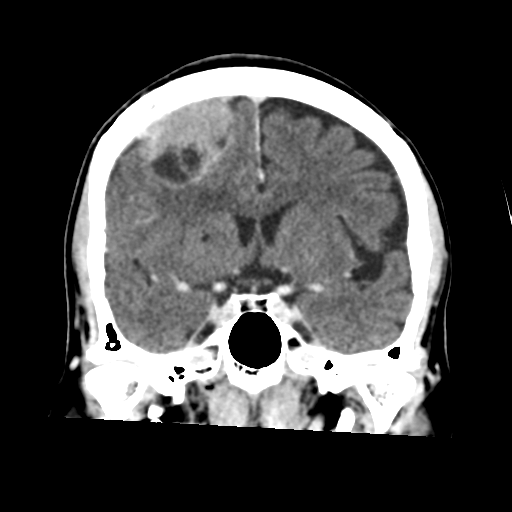 Atypical meningioma with skull invasion (Radiopaedia 34357-35649 Coronal C+ delayed 27).png