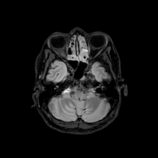 File:Autoimmune limbic encephalitis (Radiopaedia 30363-31005 Axial FLAIR 14).jpg