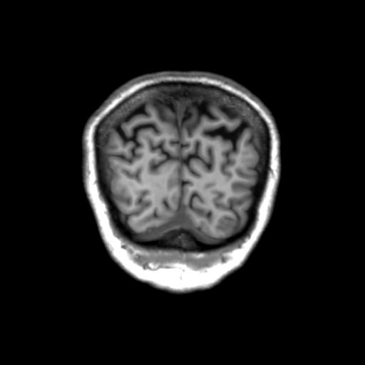 Autoimmune limbic encephalitis (Radiopaedia 30363-31005 Coronal T1 9).jpg