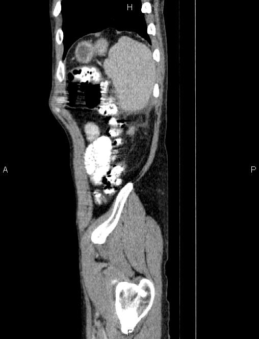 Autoimmune pancreatitis (Radiopaedia 84925-100431 E 86).jpg