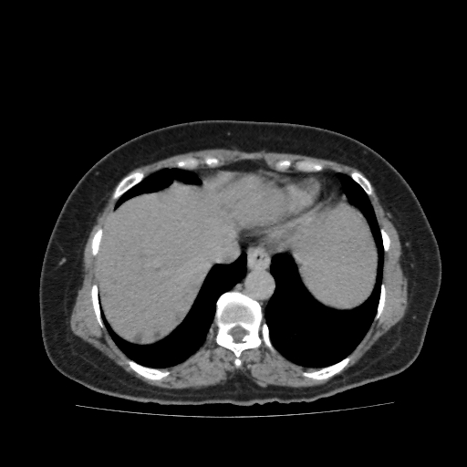 Autosomal dominant polycystic kidney disease (Radiopaedia 38189-40194 Axial C+ delayed 2).jpg