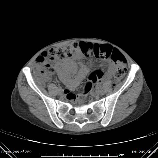File:Autosomal dominant polycystic kidney disease (Radiopaedia 44122-47684 Axial 84).jpg