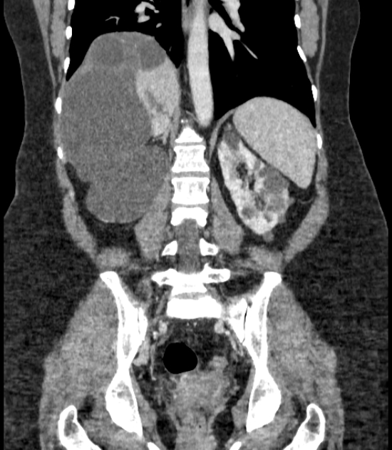 Autosomal dominant polycystic kidney disease (Radiopaedia 57124-64017 B 52).jpg
