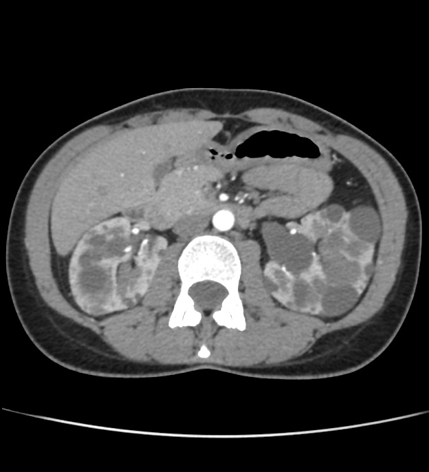 Autosomal dominant polycystic kidney disease - early onset (Radiopaedia 40734-43387 B 24).jpg