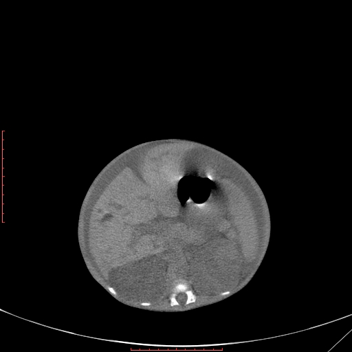 Autosomal recessive polycystic kidney disease associated with Caroli disease (Radiopaedia 61932-69984 Axial non-contrast 170).jpg