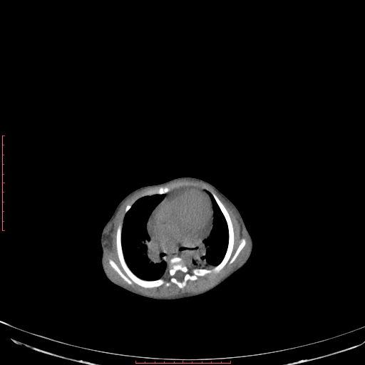 File:Autosomal recessive polycystic kidney disease associated with Caroli disease (Radiopaedia 61932-69984 B 52).jpg
