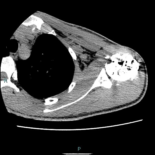 File:Avascular necrosis after fracture dislocations of the proximal humerus (Radiopaedia 88078-104653 D 40).jpg