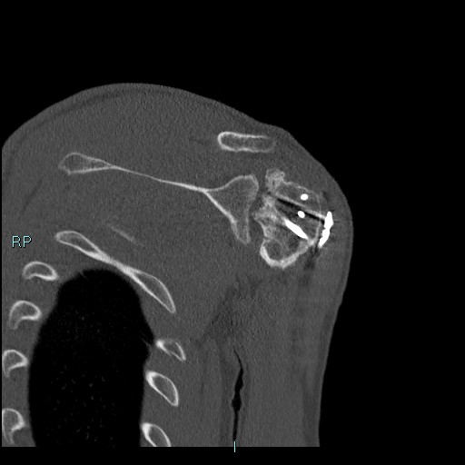 Avascular necrosis after fracture dislocations of the proximal humerus (Radiopaedia 88078-104655 Coronal bone window 88).jpg
