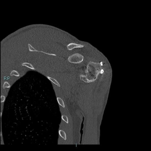 Avascular necrosis after fracture dislocations of the proximal humerus (Radiopaedia 88078-104655 Coronal bone window 98).jpg