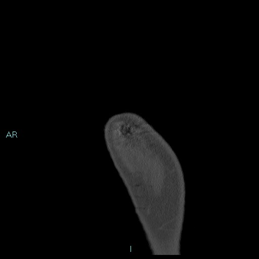 Avascular necrosis after fracture dislocations of the proximal humerus (Radiopaedia 88078-104655 Sagittal bone window 2).jpg