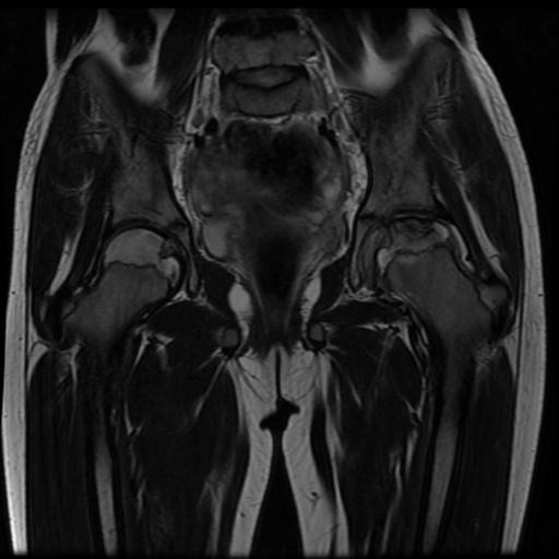 File:Avascular necrosis of the hip (Radiopaedia 29563-30067 Coronal T2 8).jpg