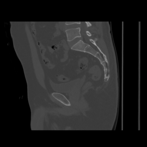 Avascular necrosis of the hip (Radiopaedia 61503-69467 B 29).jpg