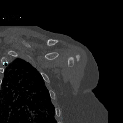 Avascular necrosis of the shoulder - Cruess stage I (Radiopaedia 77674-89887 Coronal bone window 30).jpg
