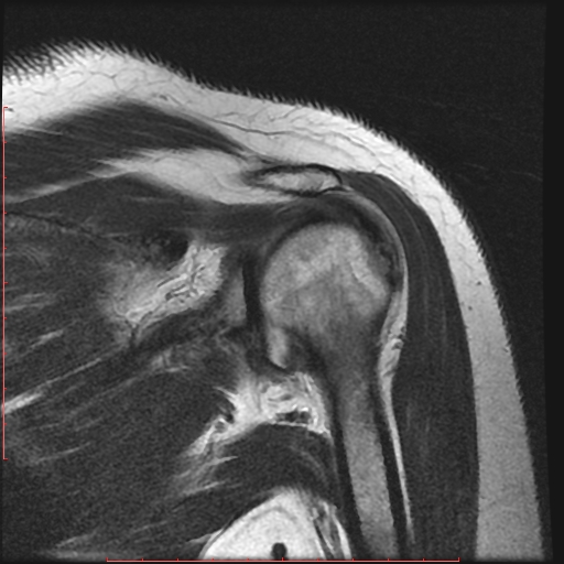 File:Avulsion fracture - greater tuberosity of humerus (Radiopaedia 25457-25703 Coronal T2 9).jpg