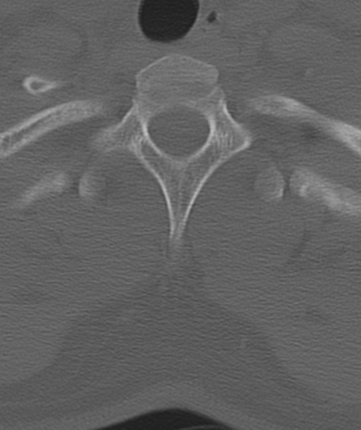 Axis peg fracture (type 3) and atlas lateral mass (type 4) fracture (Radiopaedia 37474-39324 Axial bone window 51).png