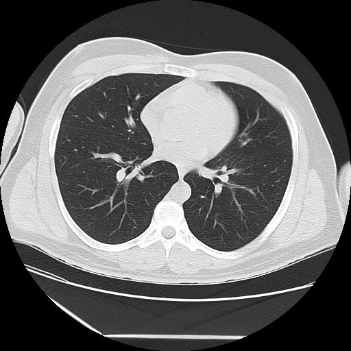 Azygos fissure (Radiopaedia 88181-104784 Axial lung window 29).jpg