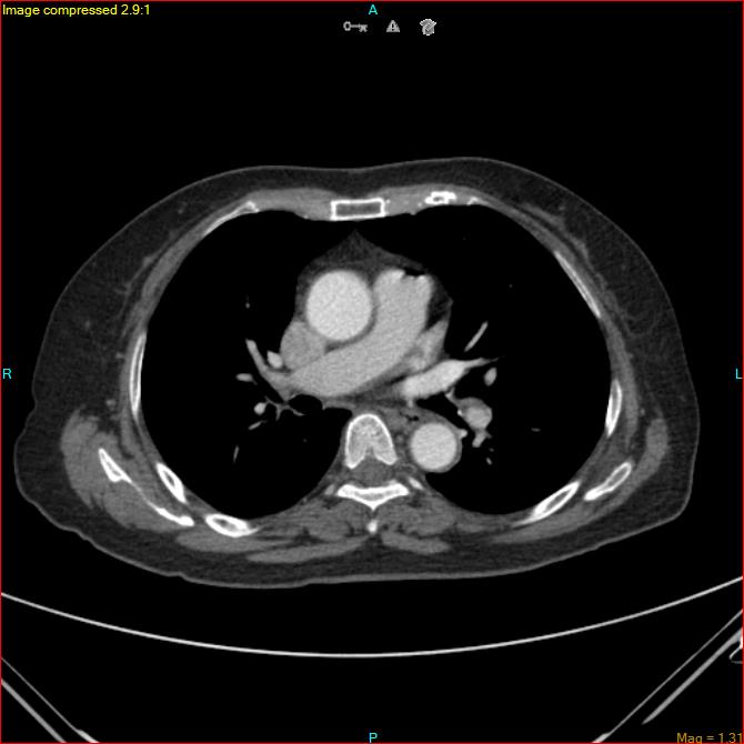 Azygos vein aneurysm (Radiopaedia 77824-90130 B 29).jpg