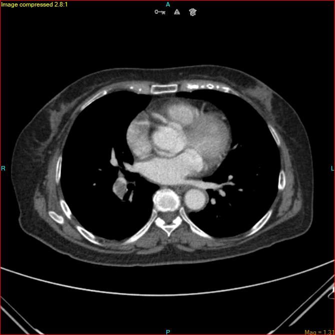Azygos vein aneurysm (Radiopaedia 77824-90130 B 34).jpg