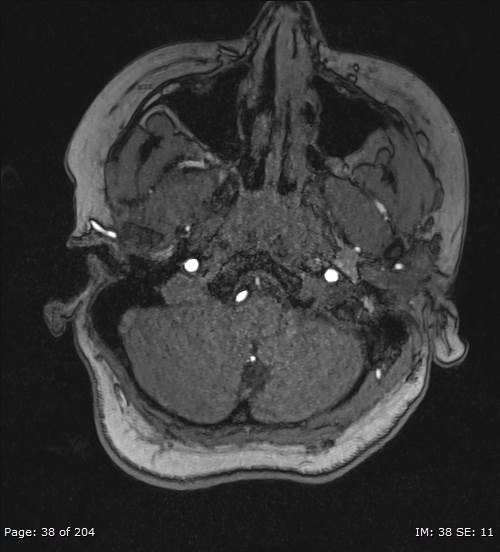 Balo concentric sclerosis (Radiopaedia 61637-69636 Axial MRA 38).jpg