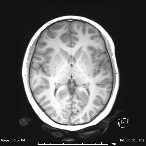 Balo concentric sclerosis (Radiopaedia 61637-69636 Axial T1 43).jpg