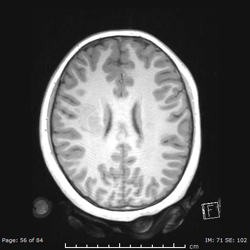 Balo concentric sclerosis (Radiopaedia 61637-69636 Axial T1 56).jpg