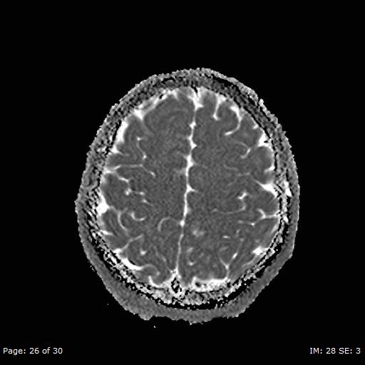 Balo concentric sclerosis (Radiopaedia 61637-69636 I 168).jpg