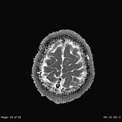 Balo concentric sclerosis (Radiopaedia 61637-69636 I 192).jpg