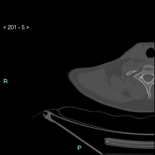 Bankart lesion with glenoid bone defect - assessment TC with PICO method (Radiopaedia 42855-93901 Axial bone window 4).jpg