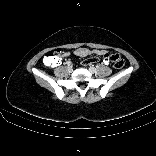 File:Bartholin gland cyst (Radiopaedia 62635-70930 Axial Post contrast 13).jpg
